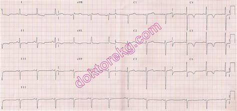 Yüksek tansiyonda EKG işaretleri